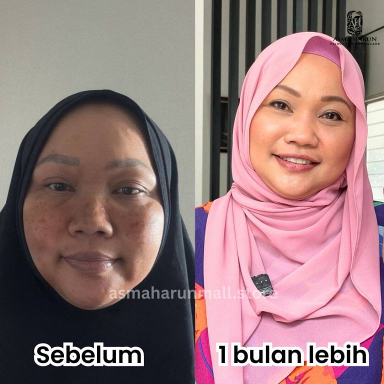 Checkout (Woo) Kak Emma, 55 Tahun - Jeragat di pipi dah berkurang sejak guna produk ustazah. Kulit makin cerah dan glowing